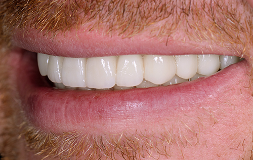After dental implants near me in Ealing