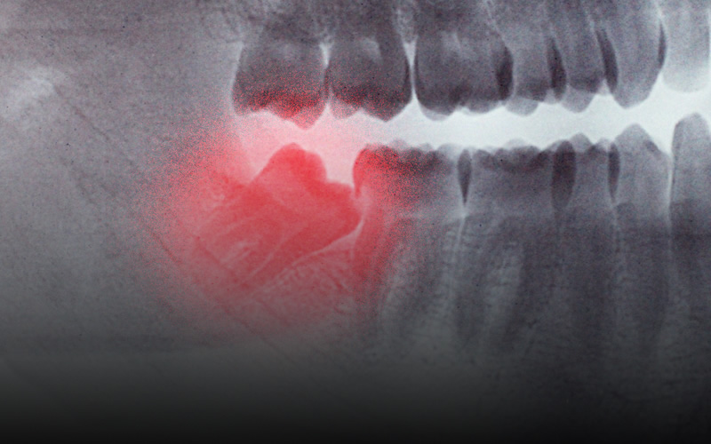Oral Surgery wisdom tooth removal London
