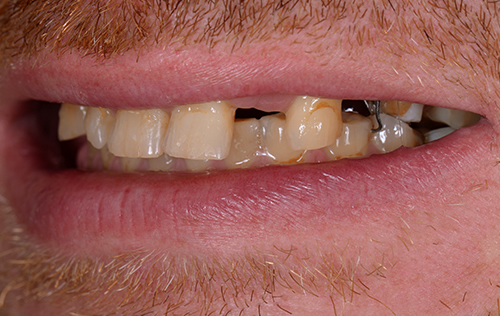 Before dental implants in Ealing