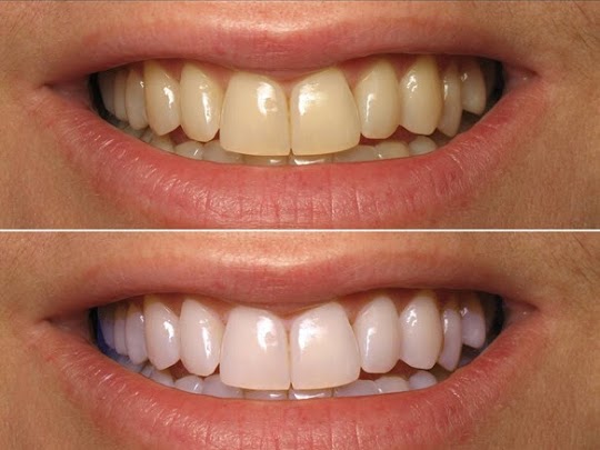 Teeth whitening near me